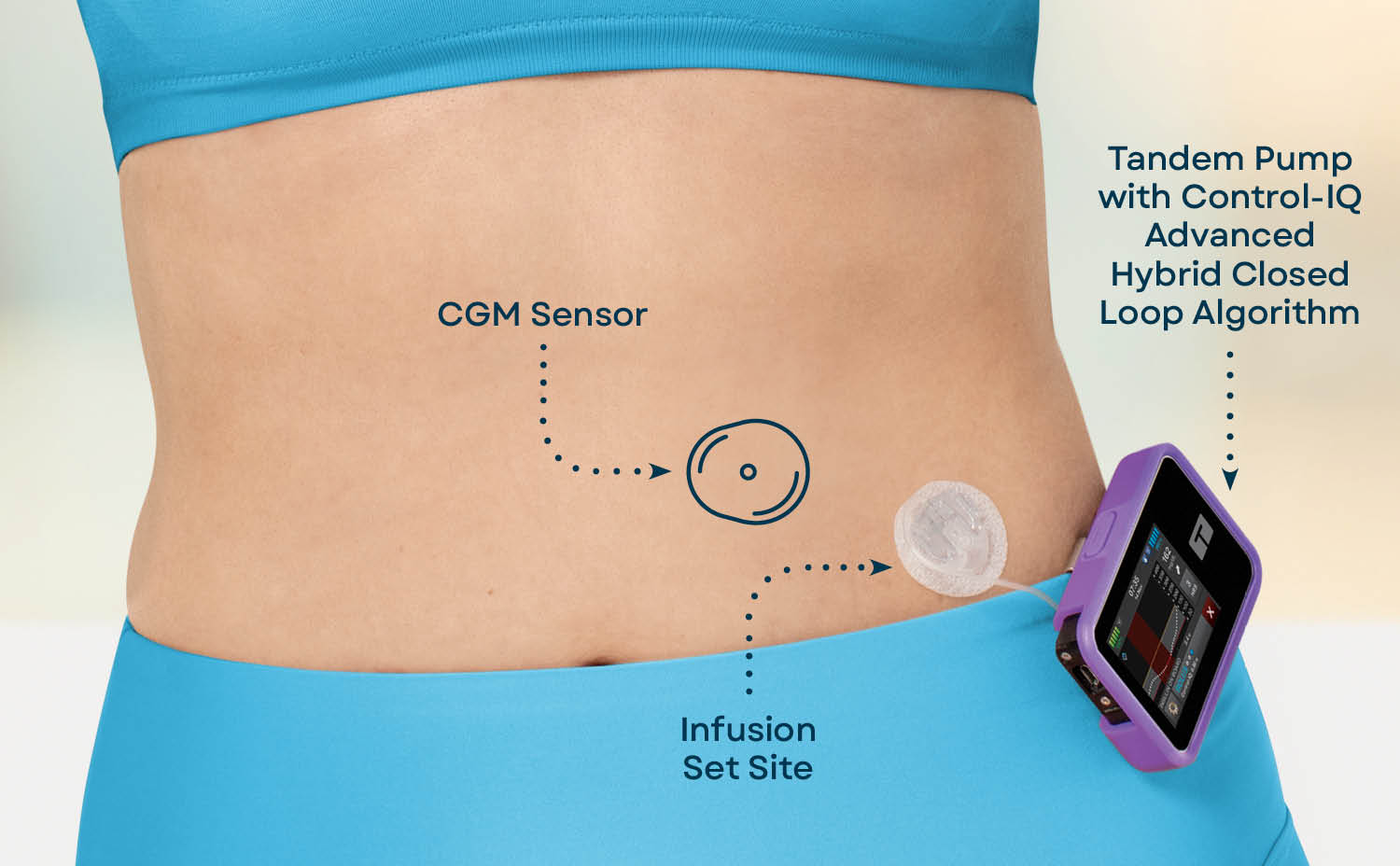 Insulin delivery system