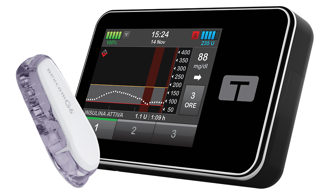 Aggiornamento con tecnologi BasalIQ Tandem Diabetes Care