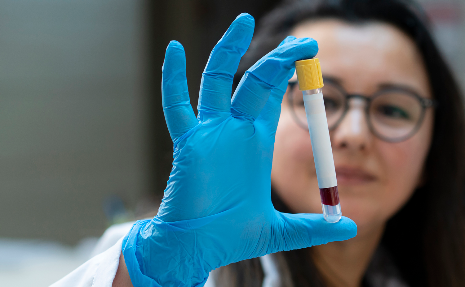 tandem-resource-A1c-bloodtest-560x560 tandem-resource-A1c-bloodtest-560x560